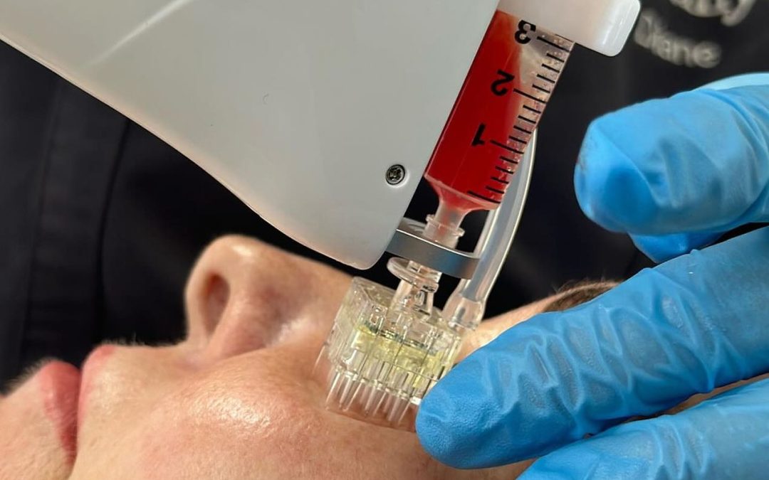 PRF (Platelet Rich Fibrin)