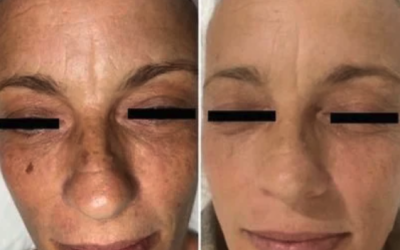 Clarity Radiance Reset Package 3x $800 for pigmentation or red veins / facial redness / rosacea